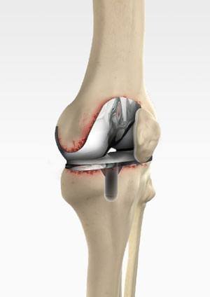 Revision Knee Replacement RKR