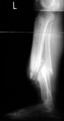 Non-Healing Fractures (nonunions) and Malunions